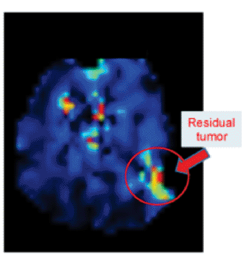 Image: Magnetic resonance spectroscopy imaging (MRSI) can show residual glioblastoma tumor after surgery. Researchers plan to use the technique to assess the effectiveness of drugs against glioblastoma (Photo courtesy of the Winship Cancer Institute of Emory University). Image: Magnetic resonance spectroscopy imaging (MRSI) can show residual glioblastoma tumor after surgery. Researchers plan to use the technique to assess the effectiveness of drugs against glioblastoma (Photo courtesy of the Winship Cancer Institute of Emory University).